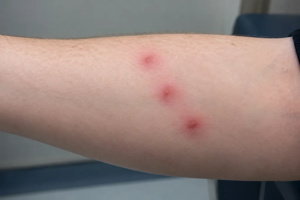 after bed bug bite